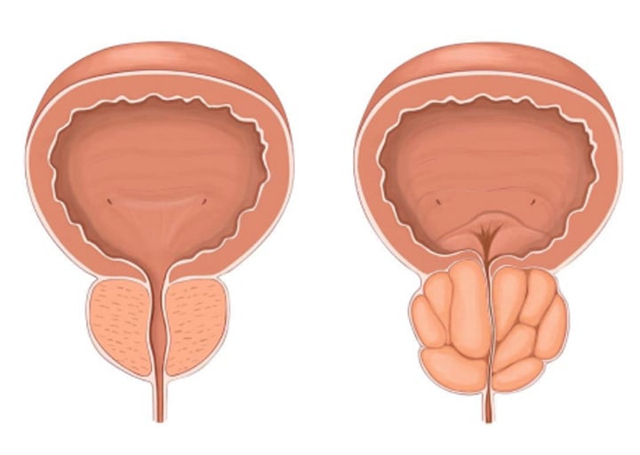Υπερπλασία προστάτη