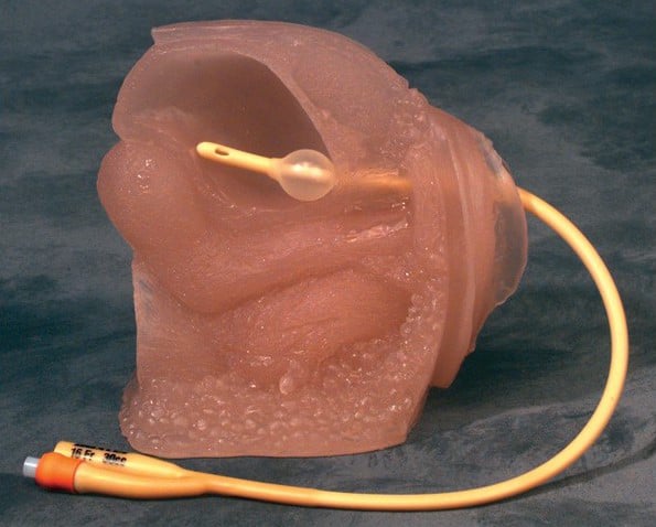 Ανώδυνη κυστεοσκόπηση