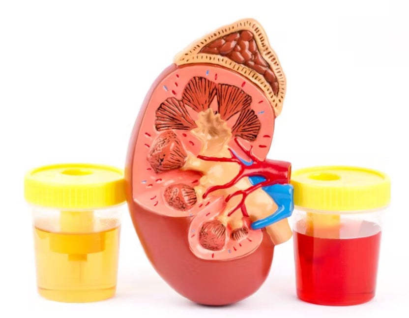 Αιματουρία