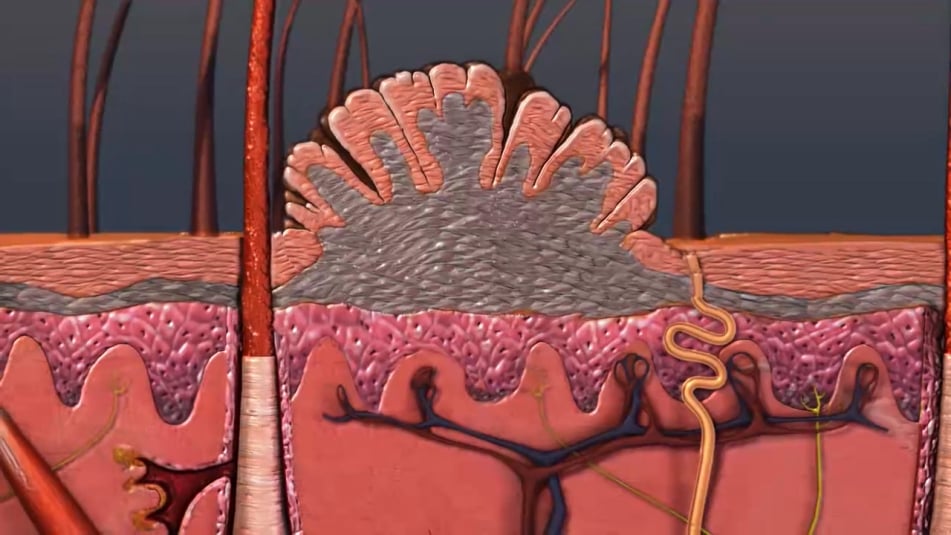 Κονδυλώματα