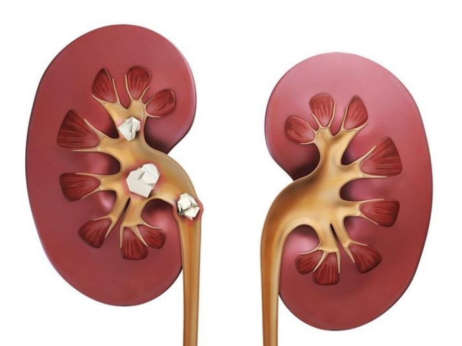 Λιθίαση νεφρών