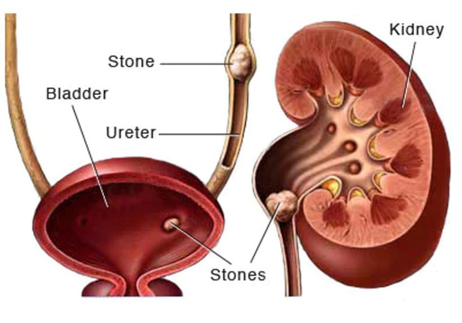 Λιθιάσεις Ουροποιητικού Συστήματος