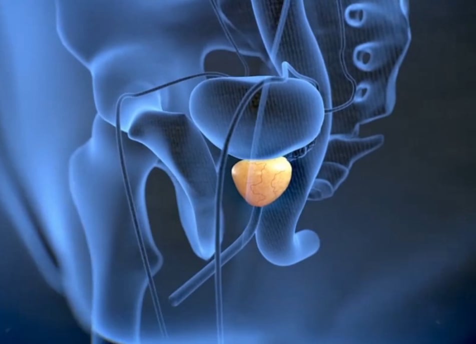 Λιθίαση προστάτη