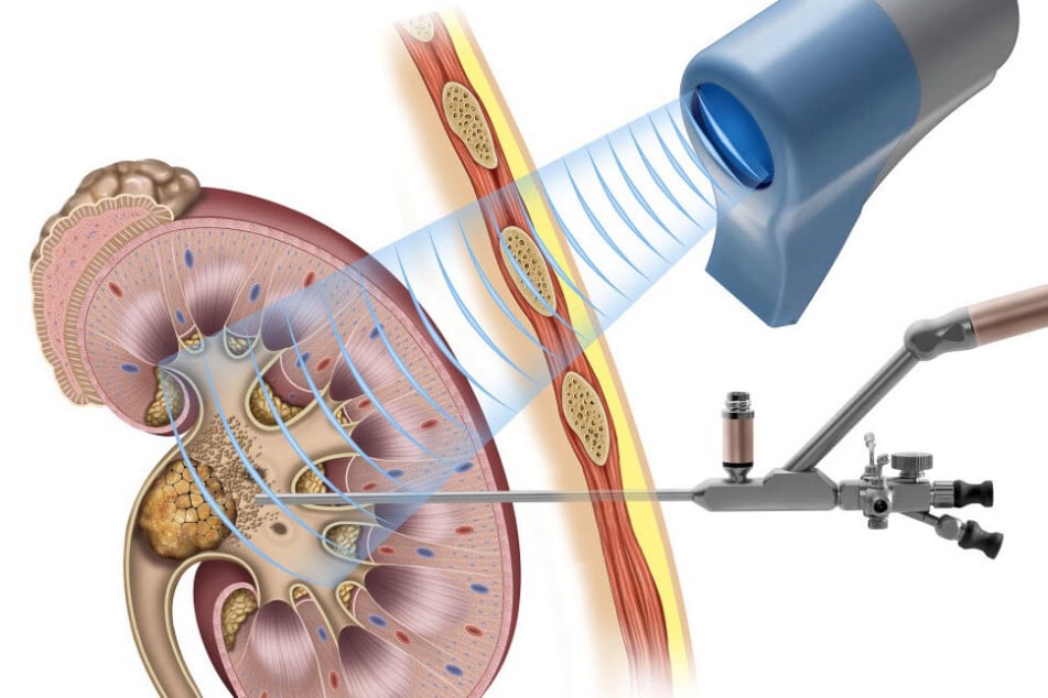 Ενδοσκοπική Λιθοτριψία