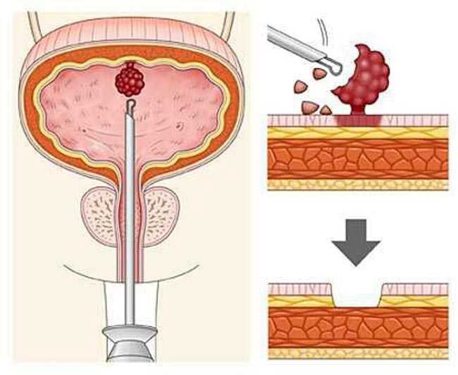 Αφαίρεση Όγκου Κύστεος