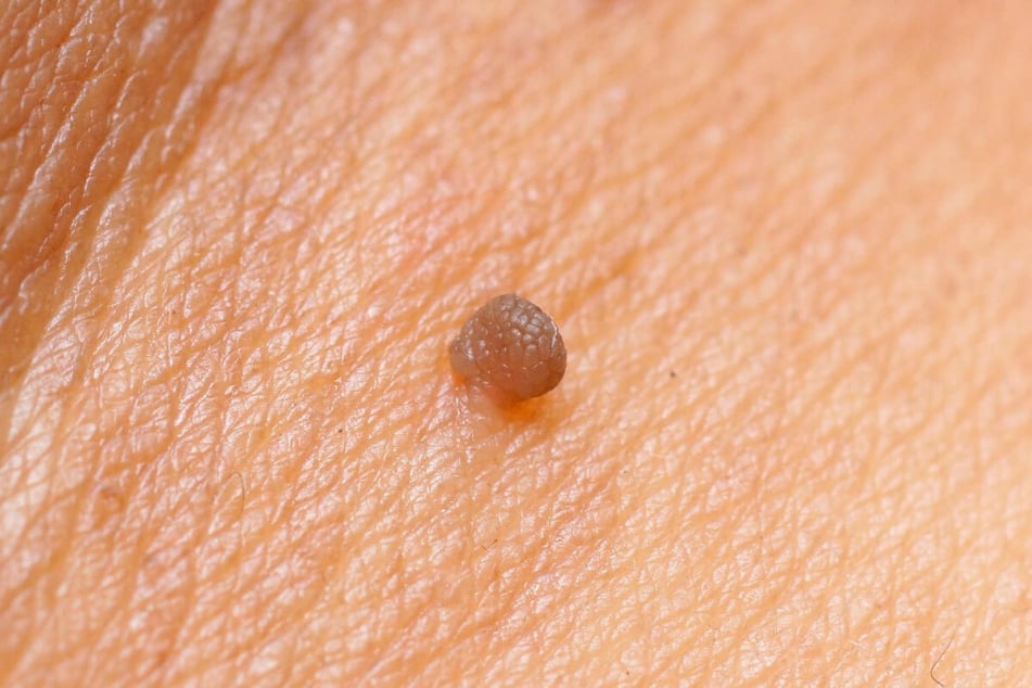 Αφαίρεση Κονδυλωμάτων