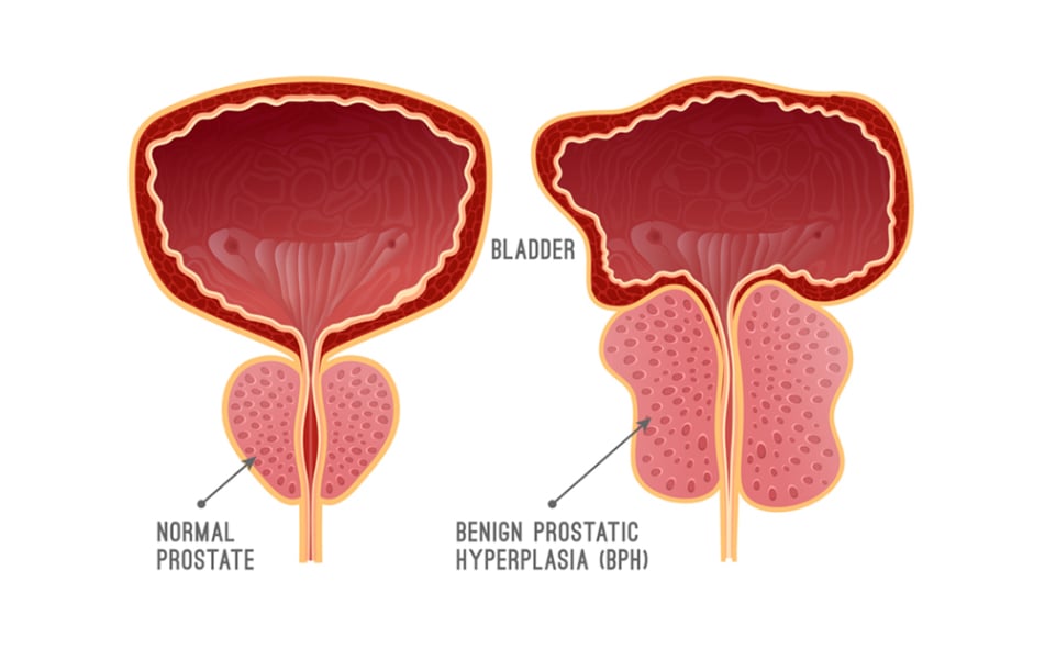 Παθήσεις Προστάτη