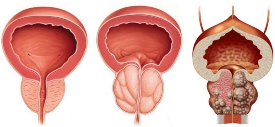 Υπερηχογραφικός έλεγχος υπερπλασίας προστάτη