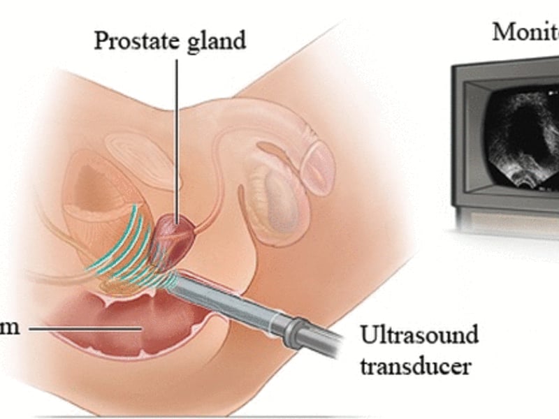 Διάγνωση - Βιοψία προστάτη – Μέτρηση & Εκτίμηση όγκου προστάτη - Laser Προστάτη